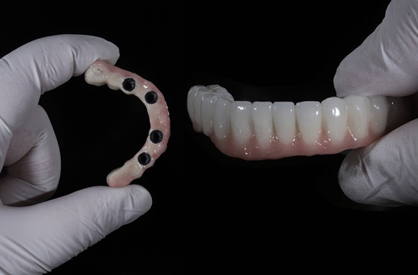 Common Issues With All On   Implants And How To Avoid Them