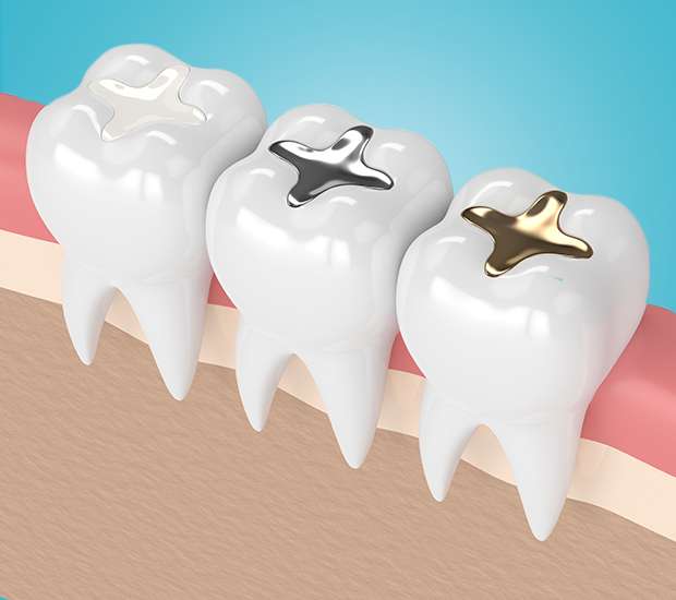 Glendale Composite Fillings