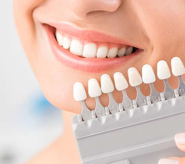 Glendale Dental Veneers and Dental Laminates